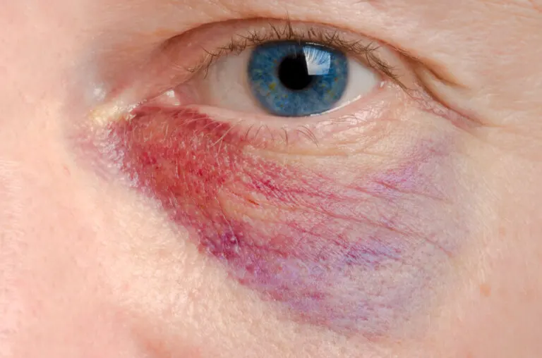 Cómo aliviar un ojo morado: 6 tratamientos naturales