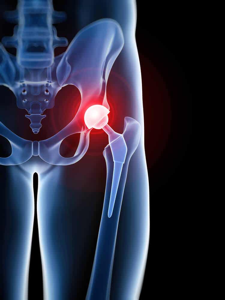 ¿Qué es una prótesis de cadera y cómo se implanta?