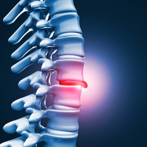 ¿Qué es una protusión discal?