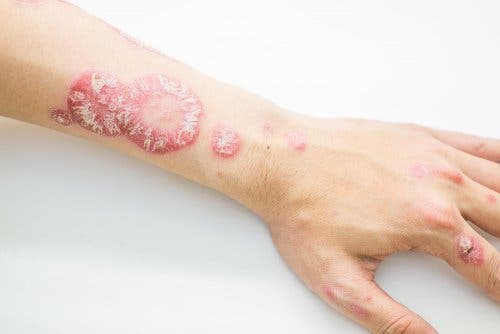Brazo con costras de psoriasis
