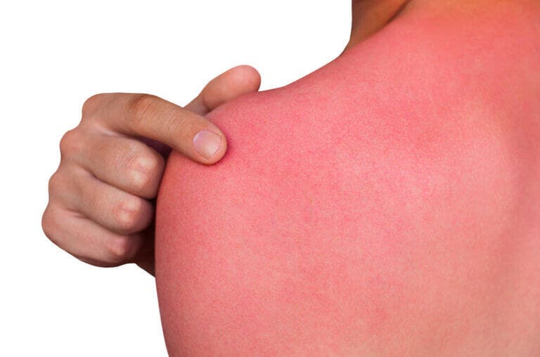 ¿Qué necesita nuestra piel cuando ha terminado el verano?