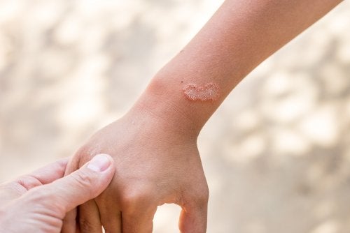 Los 8 mejores remedios naturales para eliminar los hongos de la piel