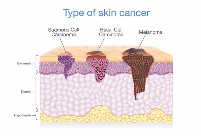 ¿Cómo es la evolución del cáncer de piel?