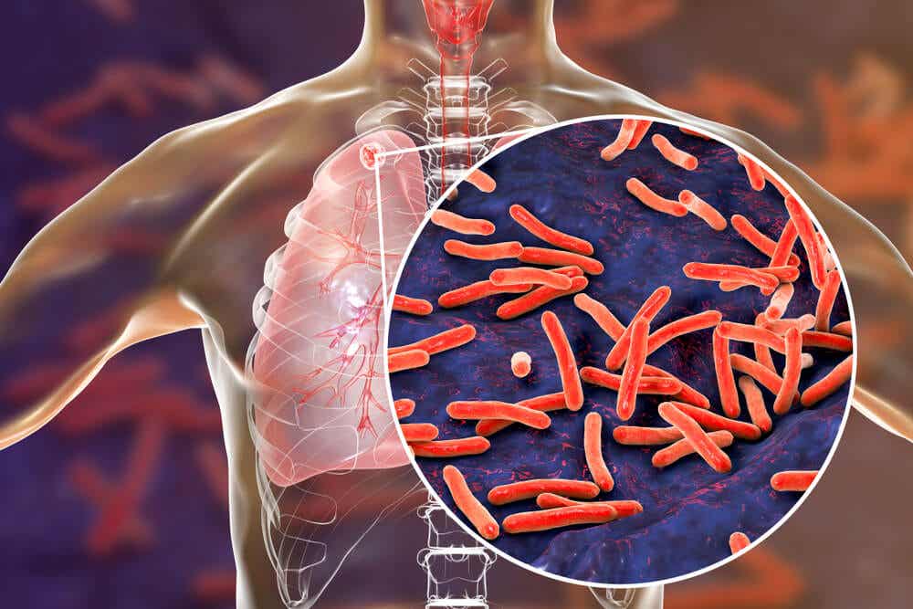 ¿Cómo se contagia la tuberculosis y cuál es su tratamiento?