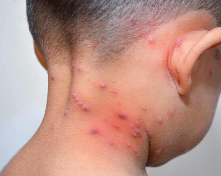 ¿Qué es la varicela? ¿Por qué sólo se tiene una vez en la vida?