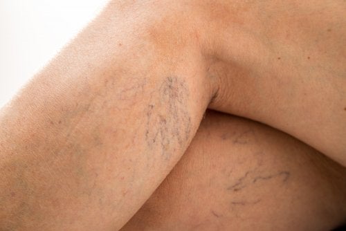 Castaño de Indias, aliado contra las varices