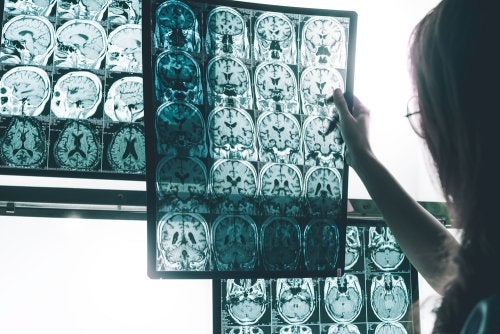 ¿Qué es el CRE Alzheimer?