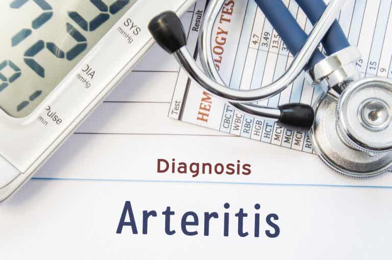 Arteritis de Takayasu: inflamación que afecta a los vasos grandes