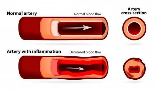 Arteritis