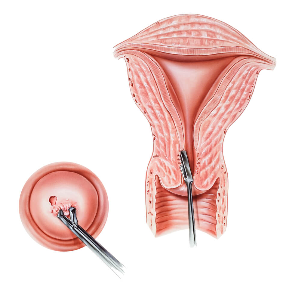 biopsie du col de l'utérus
