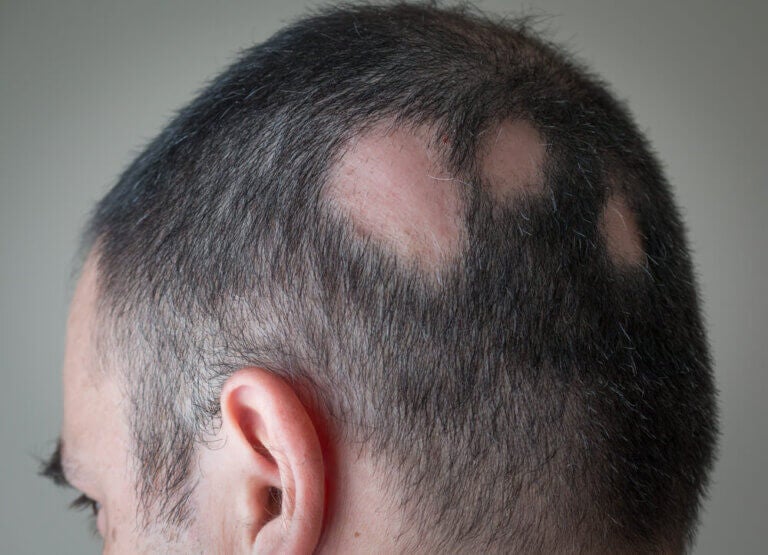 Alopecia areata: síntomas, causas y tratamientos