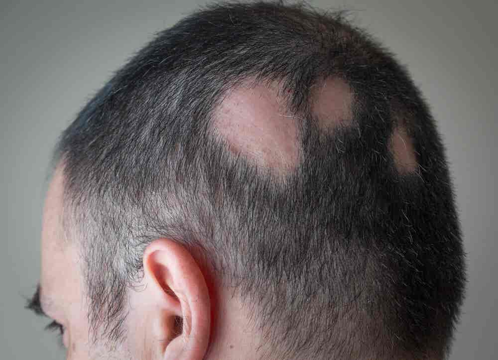 Natürliche Heilmittel für Alopezie - Mann mit kahlen Stellen am Kopf