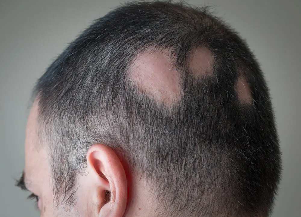 alopecia