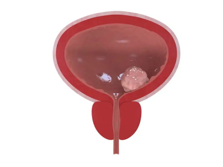 Primeros síntomas del cáncer de vejiga