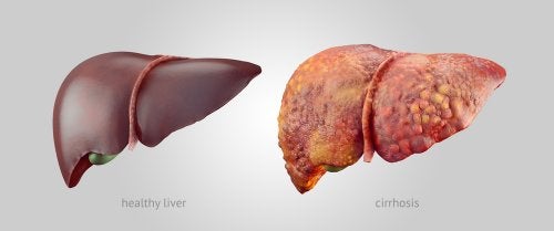 3 consejos para la cirrosis que todo paciente debe seguir