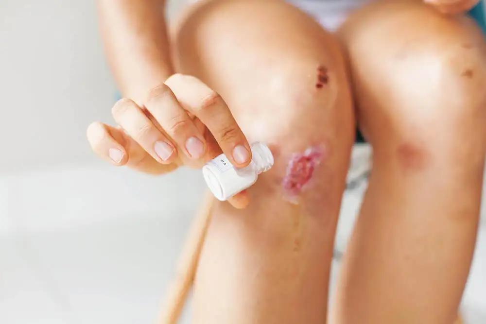 ¿Cómo cuidar una herida?