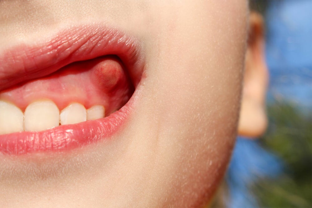 Cura el o absceso dental con remedios caseros - Mejor con Salud