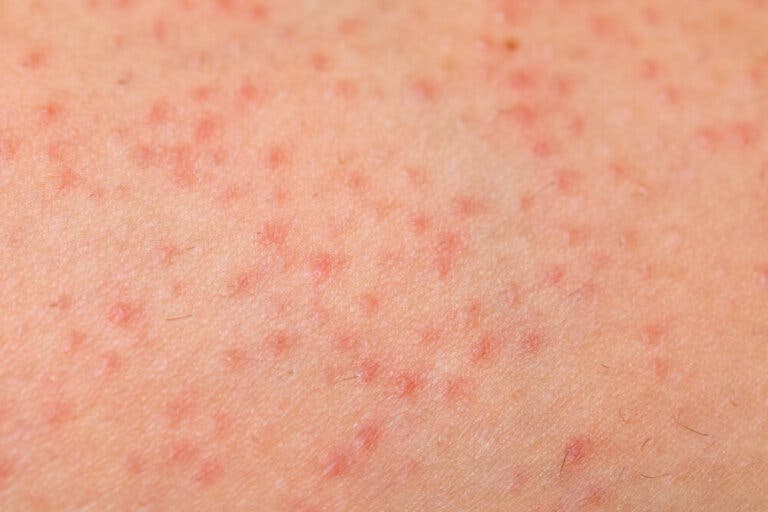 Tratamiento de la foliculitis: 7 remedios alternativos