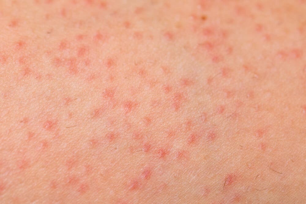 Piel con foliculitis