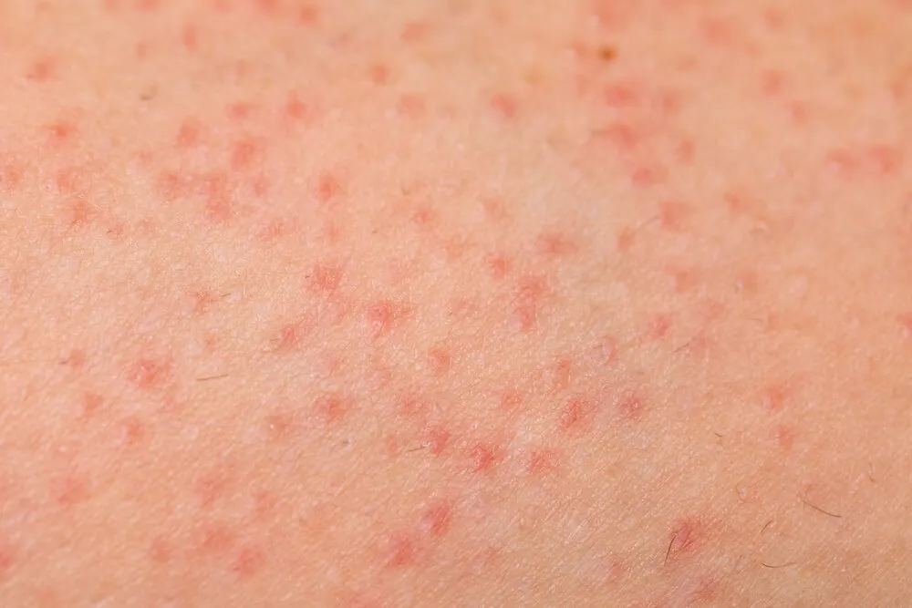 Piel con foliculitis
