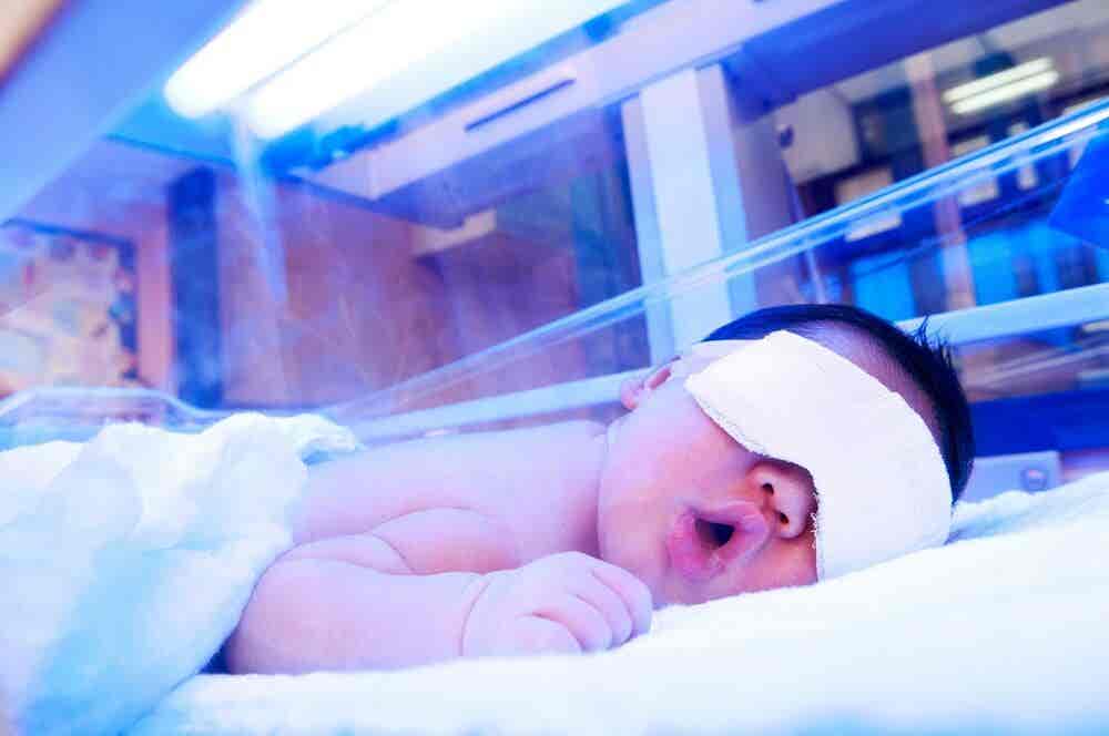 Fototerapia recién nacido con enfermedad hemolítica.