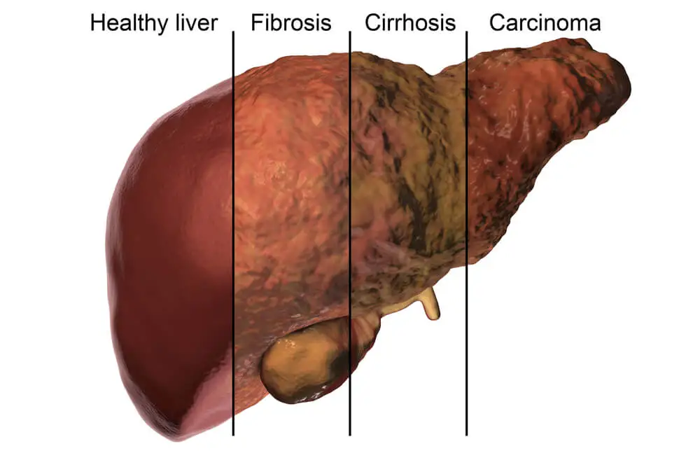 Diferentes estadíos de la salud hepática. Importancia del metabolismo hepático.