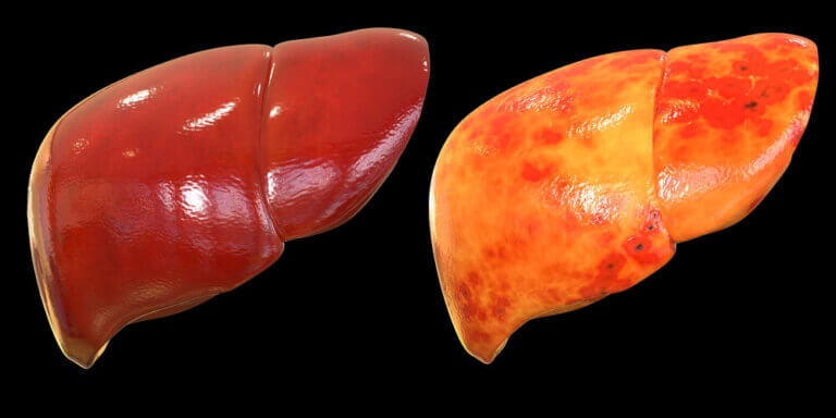¿Qué es el hígado graso? ¿Cómo se trata?