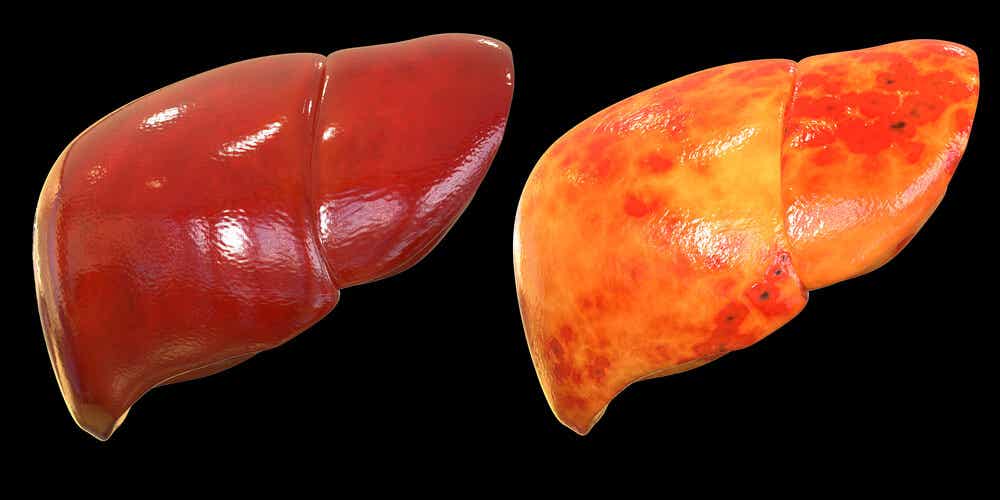 enfermedades asociadas a la obesidad: hígado graso