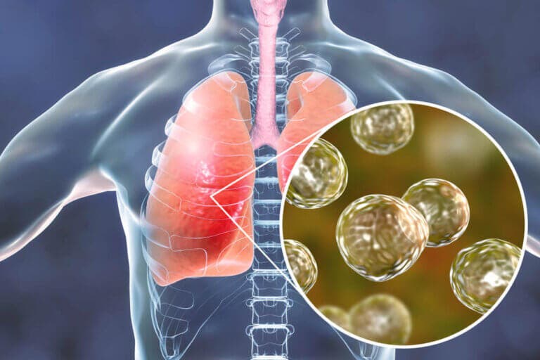 5 remedios naturales efectivos contra los síntomas de la blastomicosis
