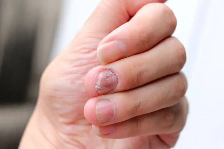 Tener hongos en las uñas: todo lo que debes saber