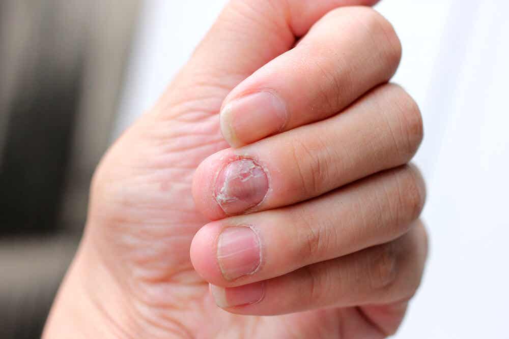 Dedos de las manos afectados por un onicomicosis