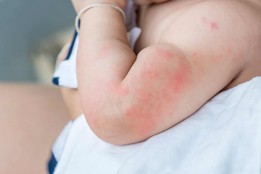 Infección de herpes durante el parto