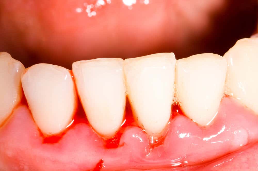 Gingivitis in the gums.
