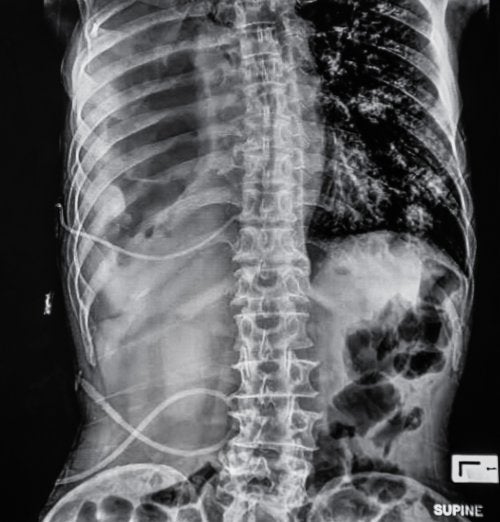 El síndrome de deficiencia muscular abdominal