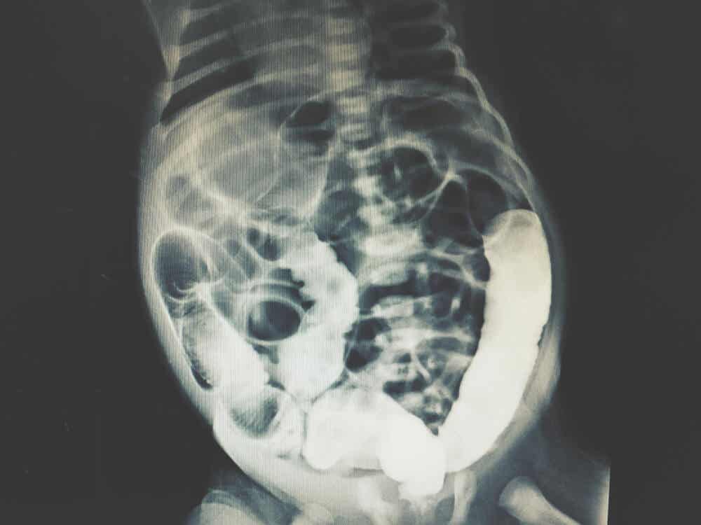 Radiografía peritoneal.