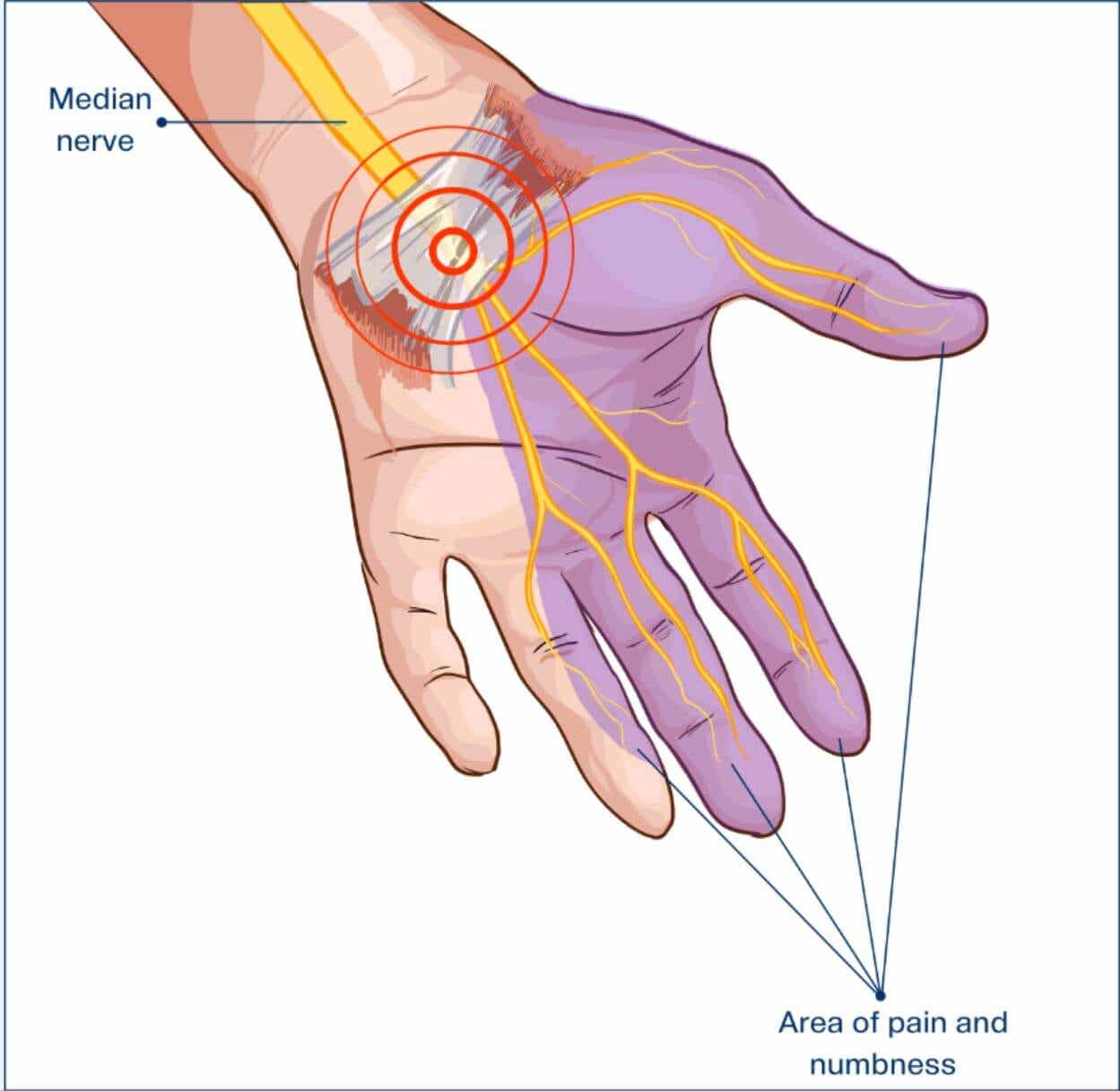 Los síntomas del síndrome del túnel carpiano se localizan en la parte baja del brazo principalmente.