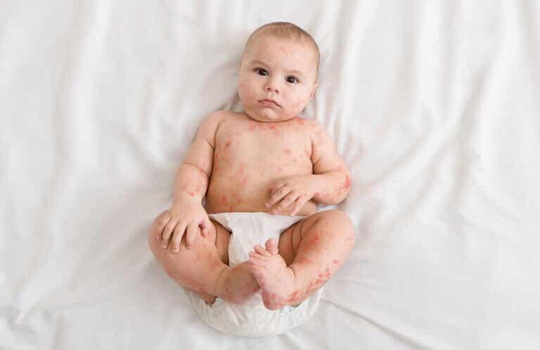 Sudamina en los bebés: ¿debo preocuparme?