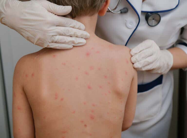 Todo lo que debes saber sobre la varicela en bebés