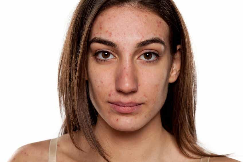 Rostro de mujer con acné.