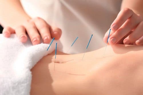 Beneficios de la acupuntura