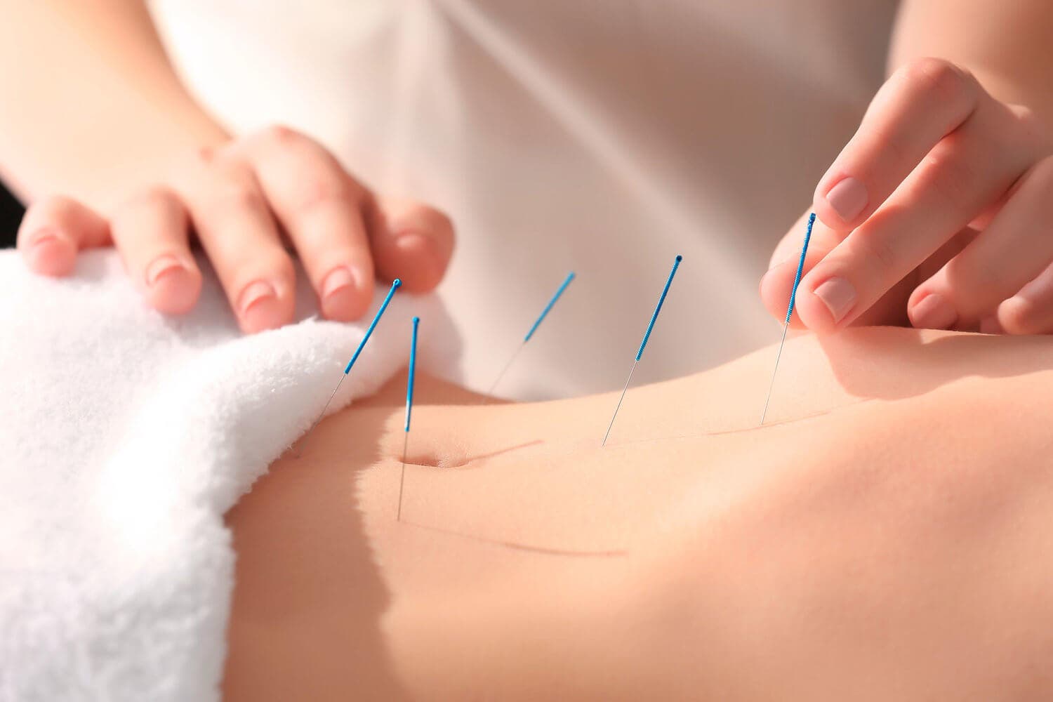 Avantages de l'acupuncture.
