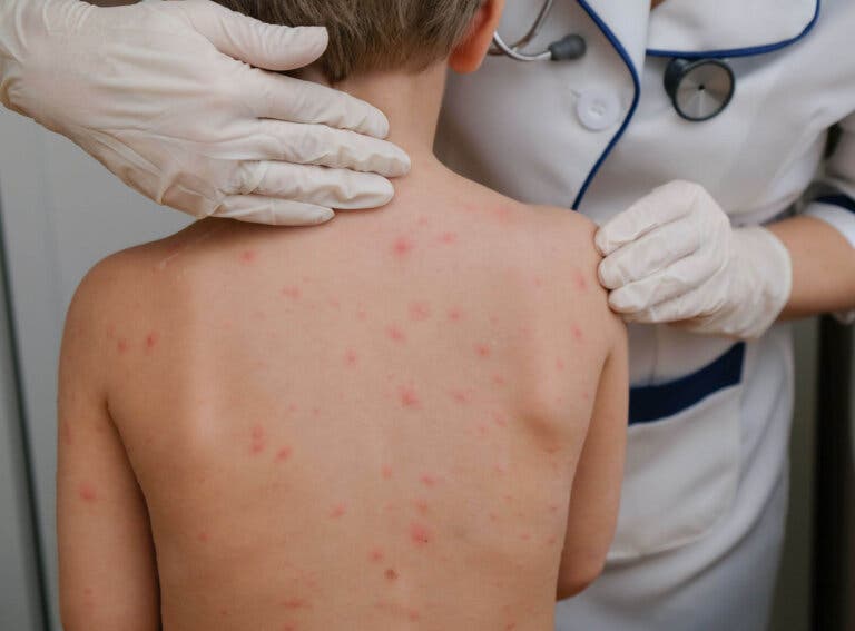 Ampollas en la piel: 7 consejos para curarlas