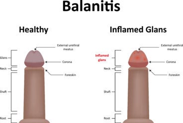 Todo acerca del tratamiento de la balanitis