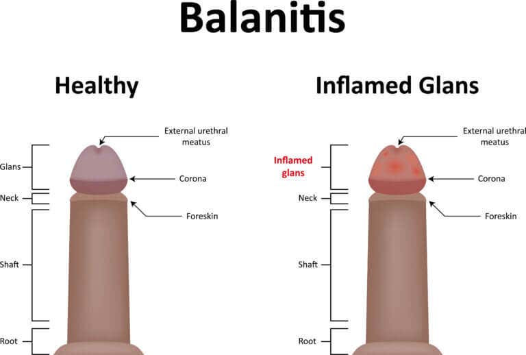 Todo acerca del tratamiento de la balanitis