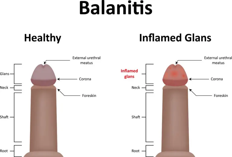 Todo acerca del tratamiento de la balanitis