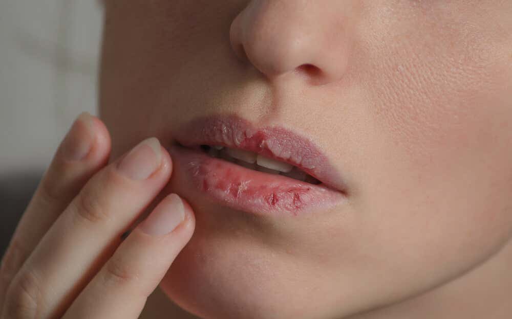Vitamin B2-Mangel - Frau mit aufgeplatzten Lippen