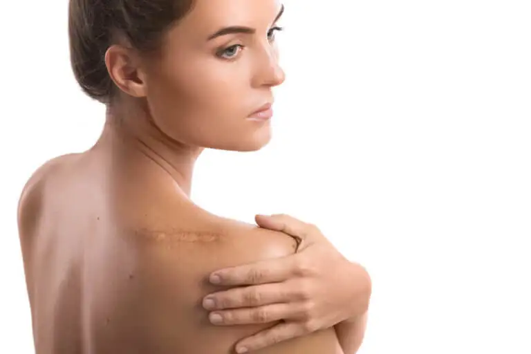 Cómo disimular las cicatrices: 5 consejos y remedios que te ayudan