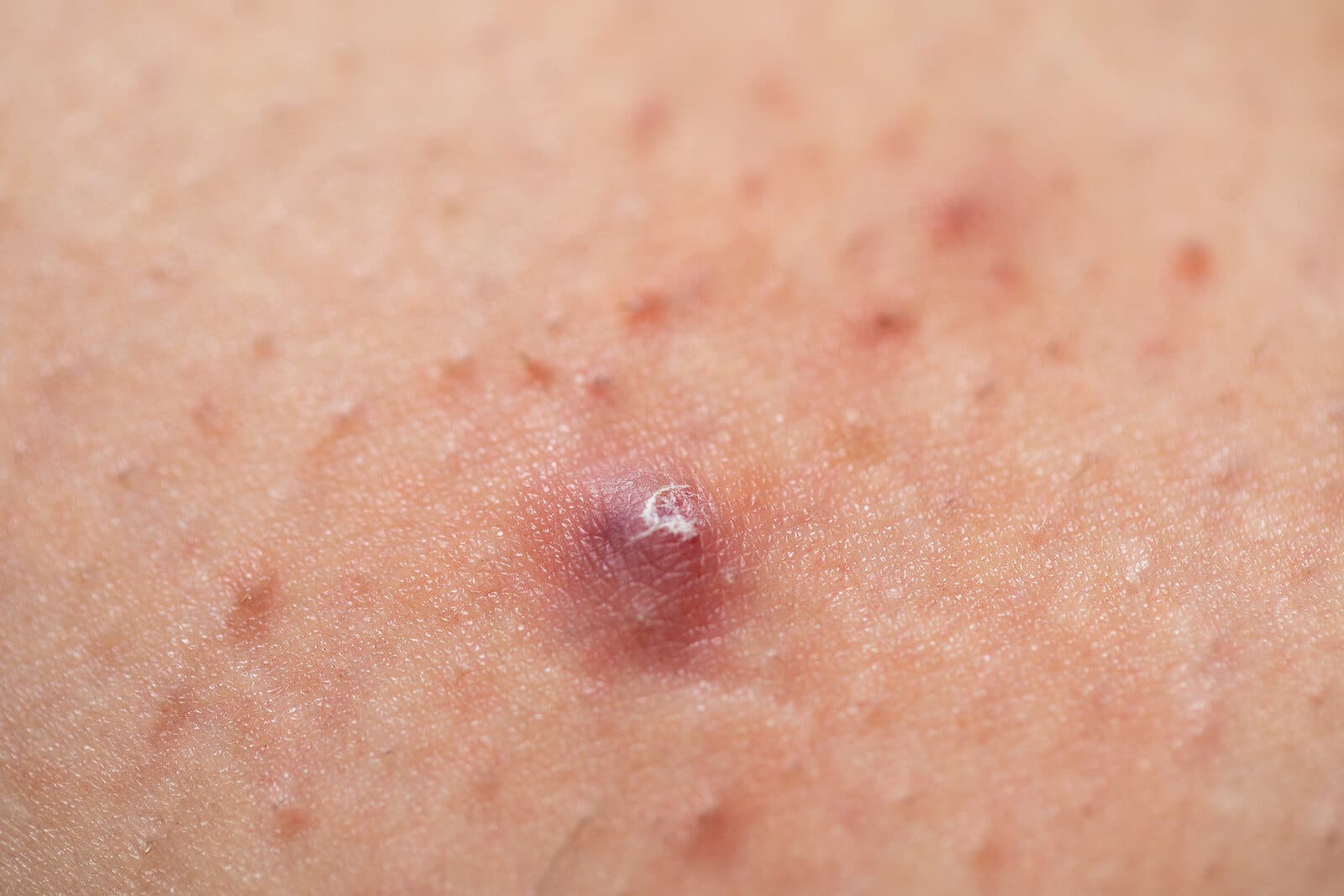 Foliculitis y granos de acné.