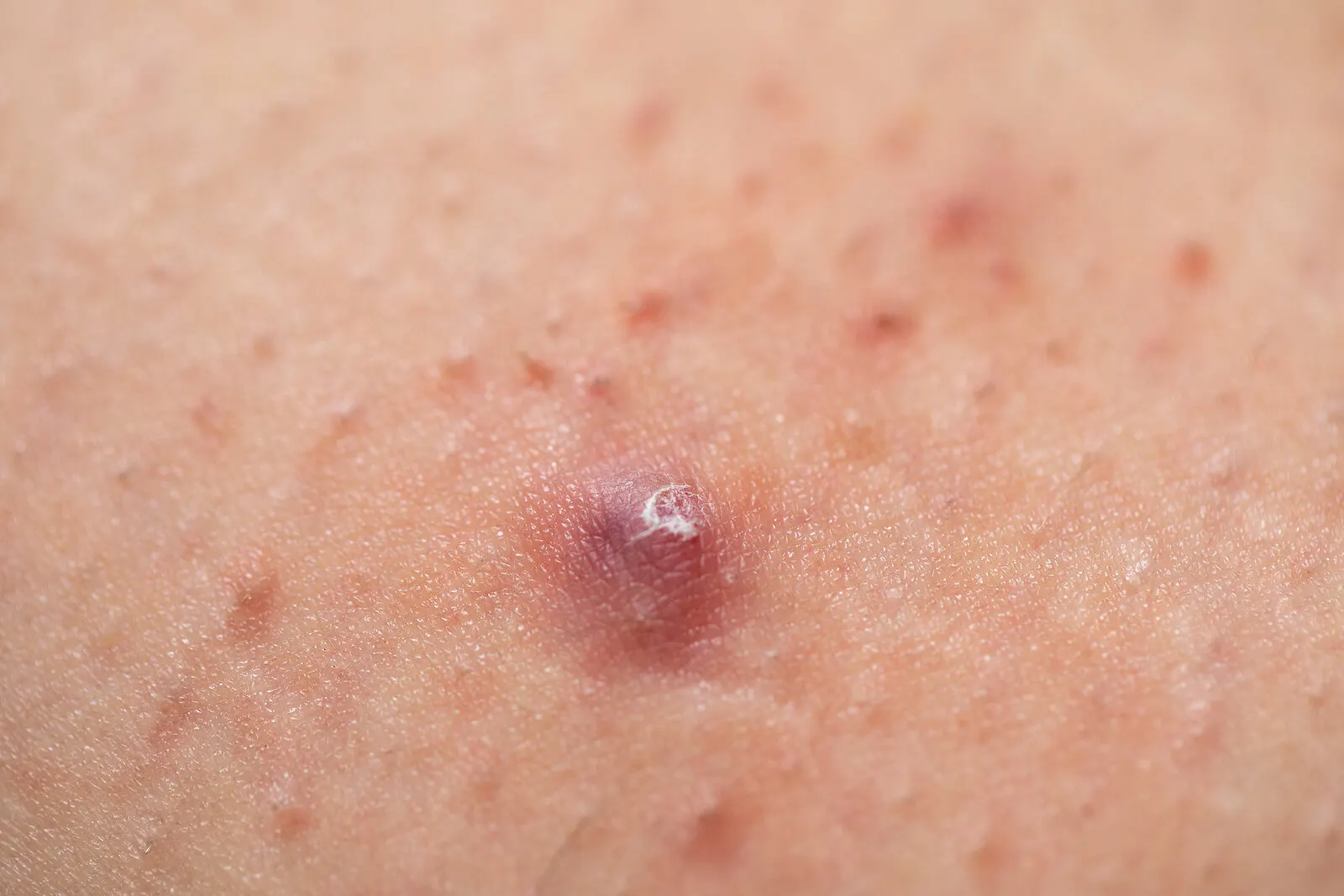 Foliculitis y granos de acné.