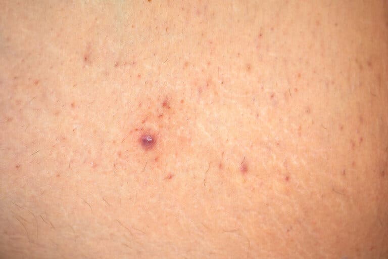 Piernas de fresa: causas y remedios caseros para eliminarlo